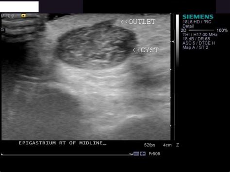 sebaceous cyst ultrasound