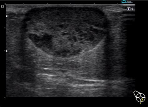 sebaceous cyst ultrasound breast