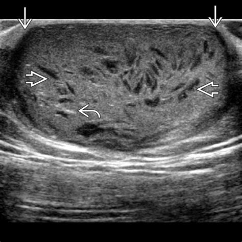 sebaceous cyst ultrasound radiology