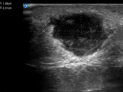 sebaceous cyst ultrasound vascularity