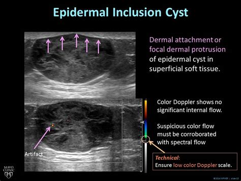 sebaceous cyst vs epidermoid cyst ultrasound