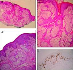 sebaceous gland hyperplasia of vulva icd 10