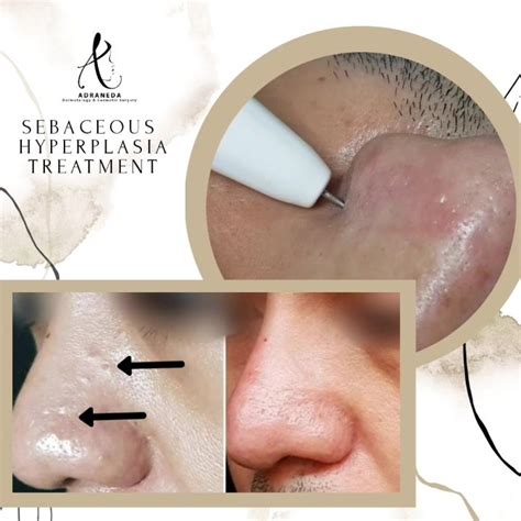 sebaceous hyperplasia nose treatment