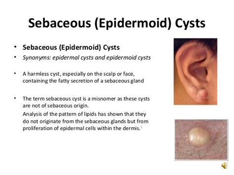 sebaceous vs epidermal cyst