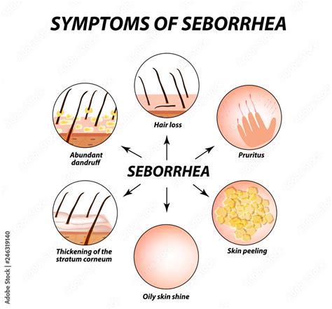 seborrhea capitis symptoms
