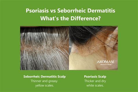 seborrhea vs psoriasis scalp