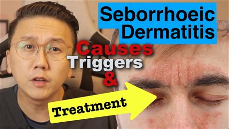 seborrheic dermatitis cure cases