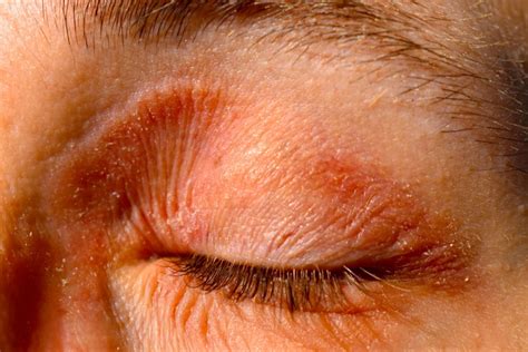 seborrheic dermatitis eyes pictures