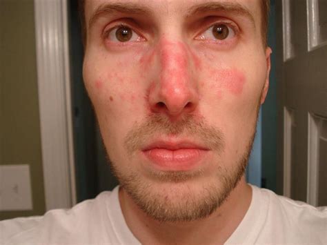 seborrheic dermatitis face treatment reddit