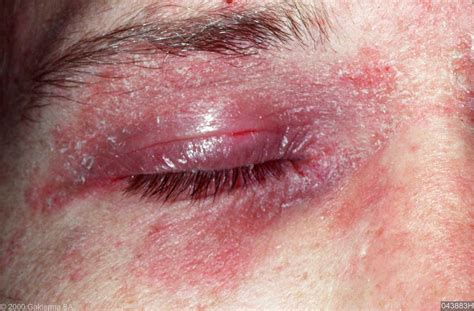 seborrheic dermatitis icd 10 eyelid