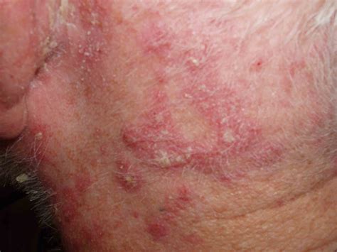 seborrheic dermatitis on body