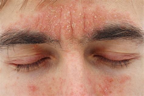 seborrheic dermatitis on skin