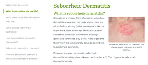 seborrheic dermatitis patient info