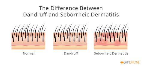 seborrheic dermatitis vs dandruff