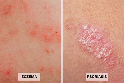 seborrheic dermatitis vs psoriasis vs eczema