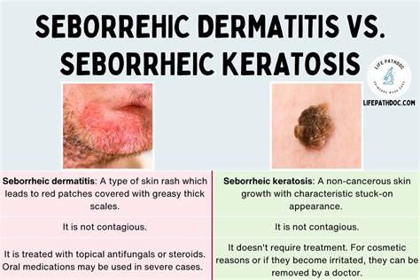 seborrheic dermatitis vs seborrheic keratosis