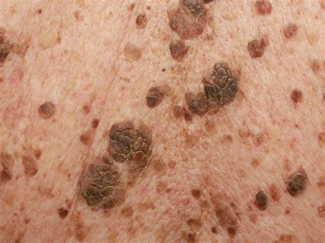 seborrheic keratosis