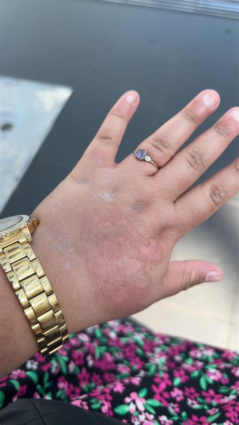 Healing Second Degree Burn Scars: Effective Treatment Options