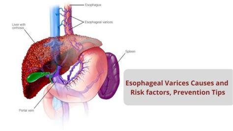 secondary esophageal varices without bleeding