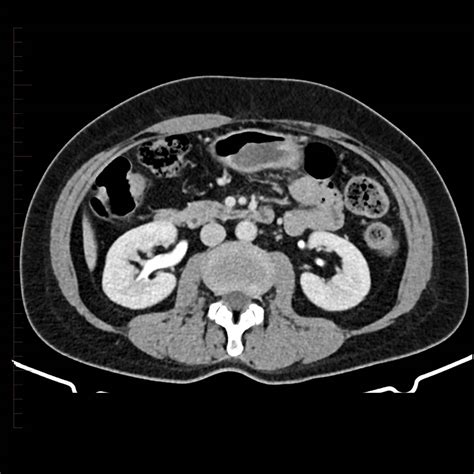 Sectional radiographic image of the kidney