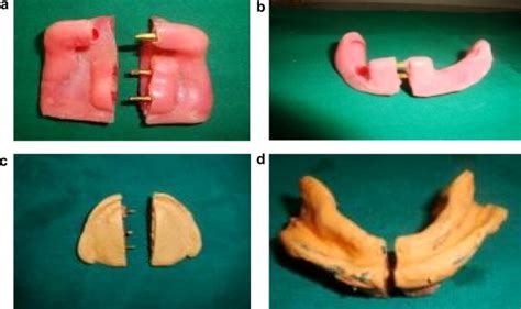Sectional Custom Impression Tray Technique
