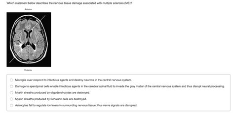 select the statement that correctly describes multiple sclerosis