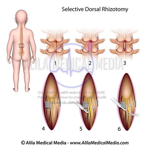Understanding Selective Dorsal Rhizotomy: A Life-Changing Treatment for Cerebral Palsy and Spasticity