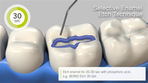 Selective Etching Dental