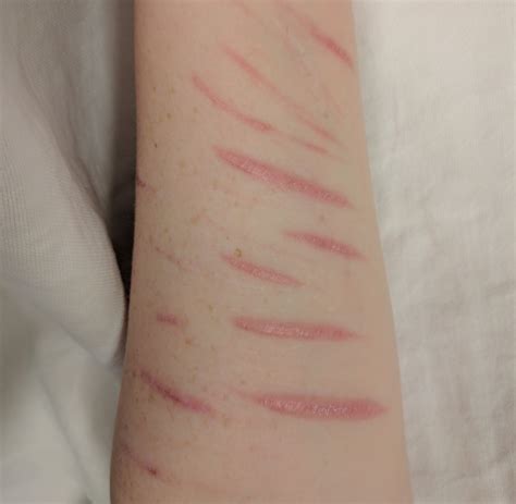 Understanding and Addressing Self Harm Marks: A Guide to Healing and Support