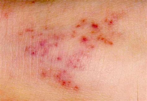 sepsis infection images on skin rash