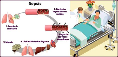 sepsis y septicemia es lo mismo