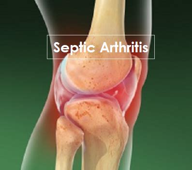 Septic Arthritis Joint Replacement