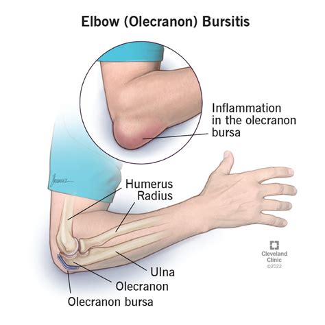 Septic Bursitis Elbow: Causes, Symptoms, and Effective Treatment Options