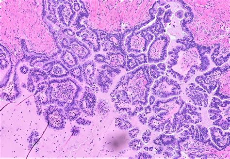 serous borderline ovarian tumor