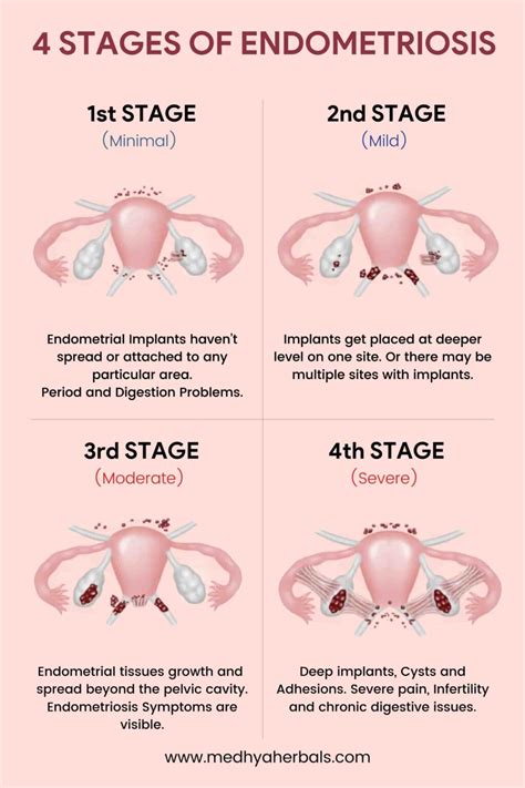severe endometriosis disease stage 4