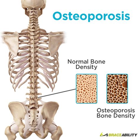 severe osteoporosis of the spine