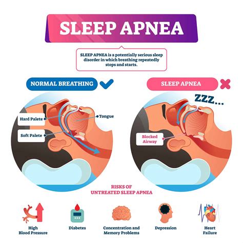 severe sleep apnea causes