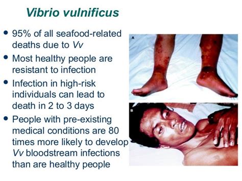 severe vibrio vulnificus infections