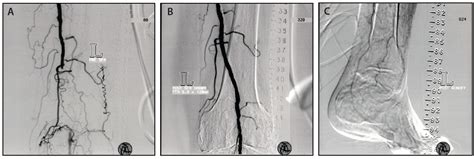 sfa stenosis medical abbreviation