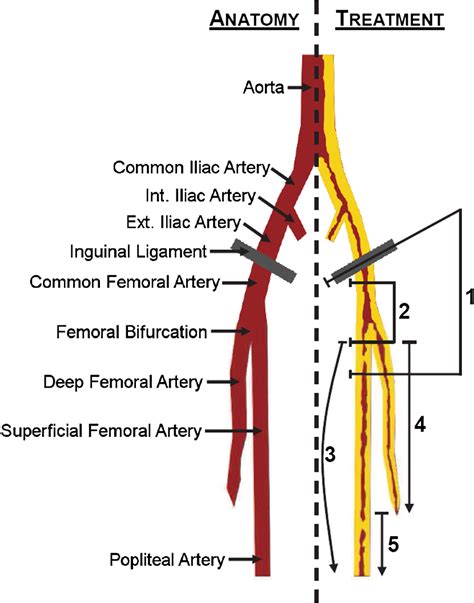 sfa vein or artery