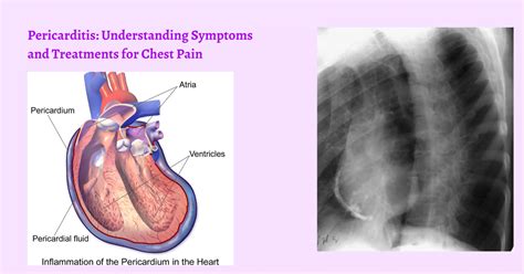 Sharp Chest Pain Pericarditis