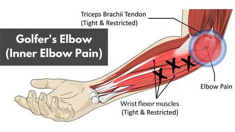 Sharp Pain In Forearm When Lifting