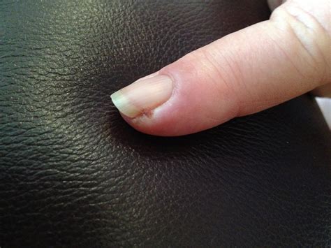 Sharp Pain Under Fingernail When Pressed