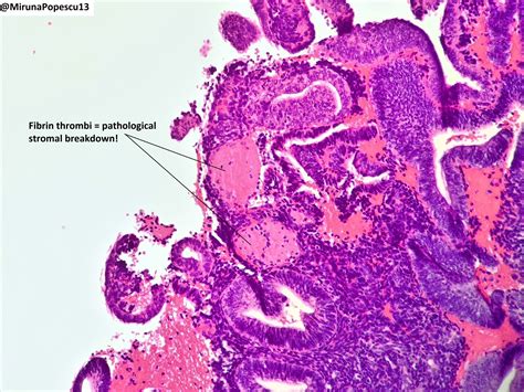 shedding endometrium pathology outlines