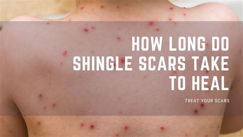 Shingle Scars