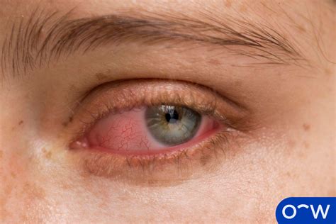 Shingles Inside Eye: Recognizing and Treating Ocular Complications