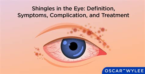 Understanding Shingles of the Eye: Causes, Symptoms, and Treatment Options