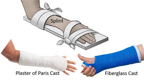 Short Arm Cast Vs Splint