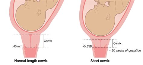 Short Cervix Kemh