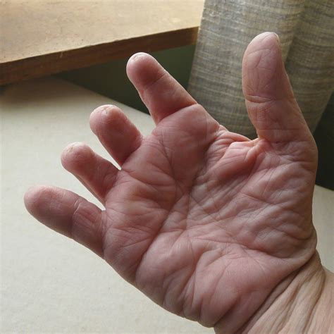 short stubby fingers syndrome